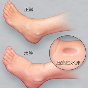 Qigong para Edemas